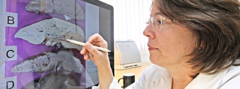 Molécula aponta predisposição a câncer no fígado e permite antecipar cuidados para evitar doença